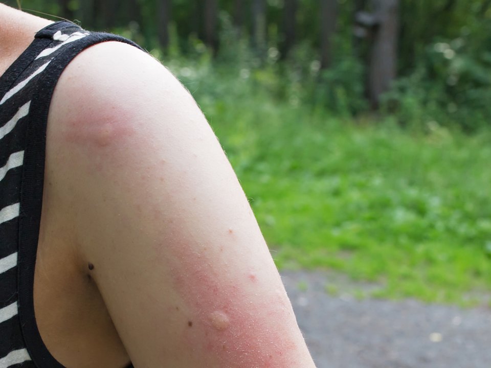 5 кращих способів безпечно знеболити шкіру і зняти з неї запалення