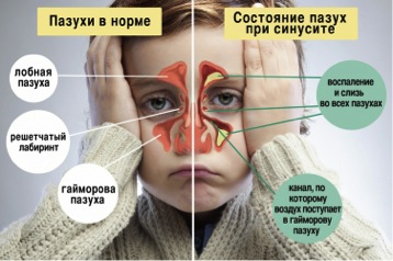 6 ефективних способів допомогти дитині перемогти гайморит