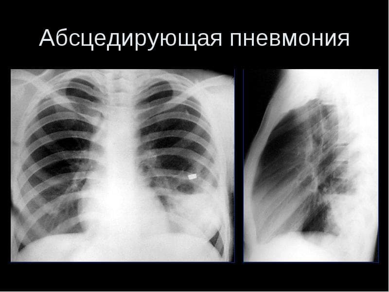 Абсцедуюча пневмонія симптоми і лікування
