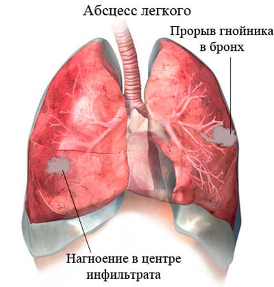 Абсцедуюча пневмонія симптоми і лікування