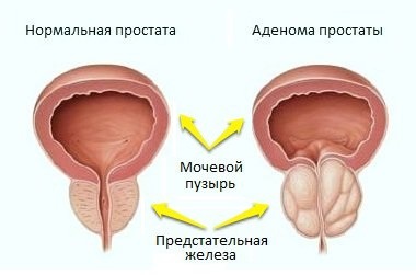 Аденома передміхурової залози захворювання та лікування