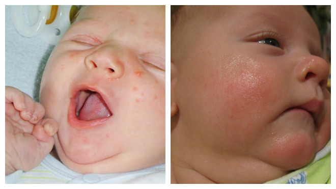 Алергічний кашель у дитини лікування