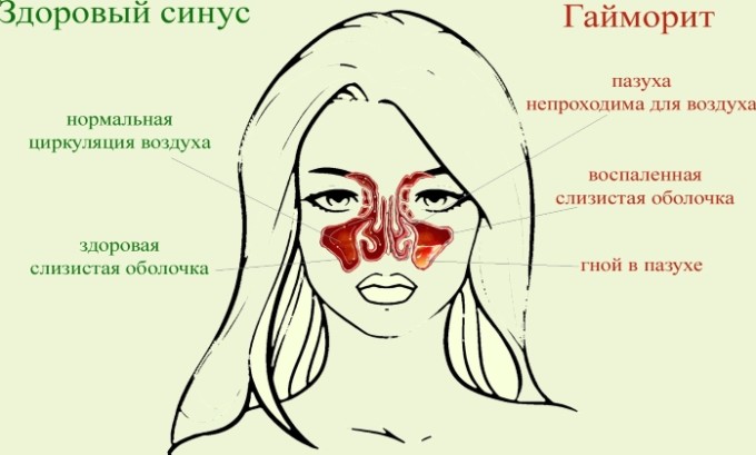Амоксицилін Клавуланова кислота: інструкція по застосуванню