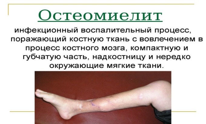 Амоксицилін Клавуланова кислота: інструкція по застосуванню