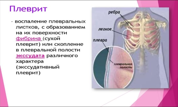 Амоксицилін Клавуланова кислота: інструкція по застосуванню