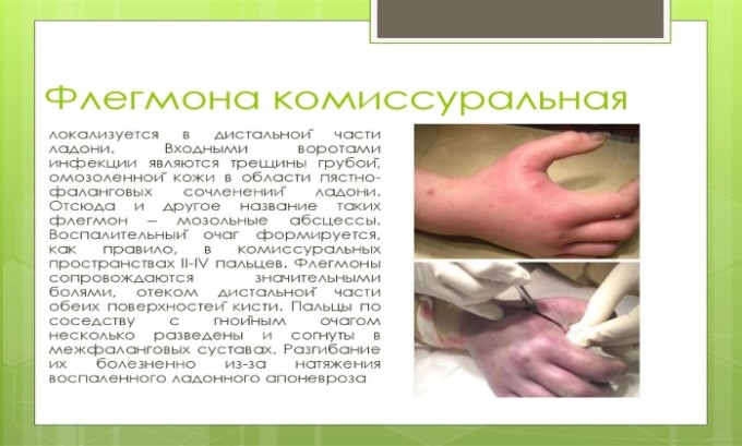Амоксицилін Клавуланова кислота: інструкція по застосуванню