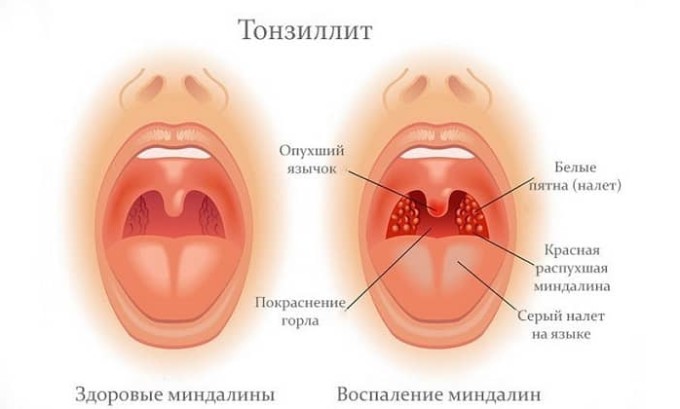 Амоксицилін Клавуланова кислота: інструкція по застосуванню