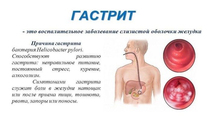 Амоксицилін Клавуланова кислота: інструкція по застосуванню