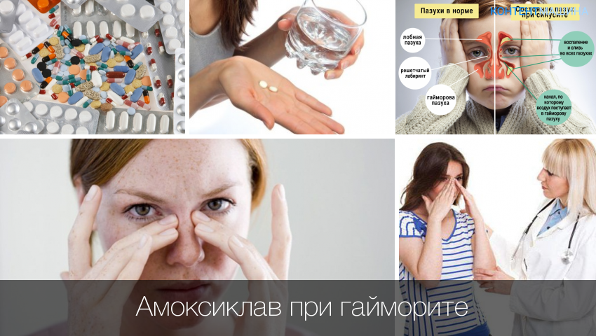 Амоксиклав при гаймориті (синуситі), як брати і скільки днів пити