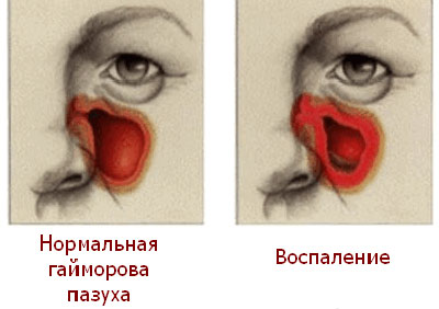 Амоксиклав при гаймориті (синуситі), як брати і скільки днів пити