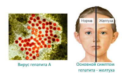 Амоксиклав при гаймориті (синуситі), як брати і скільки днів пити