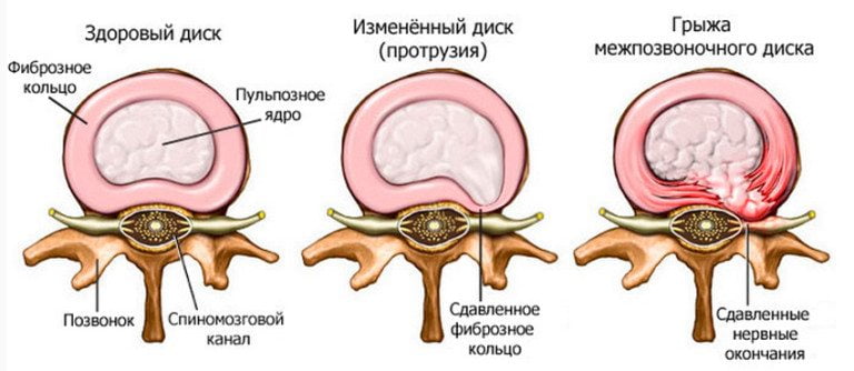 Анатомія шиї людини російською. Чому виникають і які бувають хвороби шиї людини? Межфасціальние простору шиї