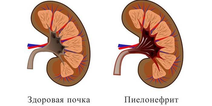 Ангіна грибкового типу