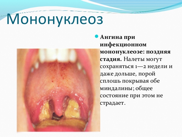 Ангіна при інфекційному мононуклеозі як відрізнити ці захворювання
