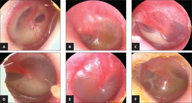 Антибіотик при отиту середнього вуха види та особливості лікування
