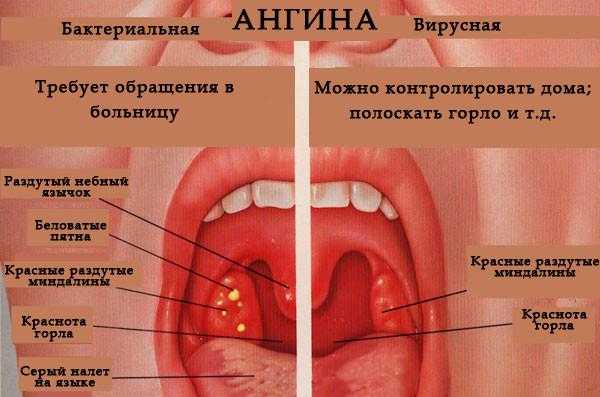 Антибіотики при болю в горлі без температури у дорослого