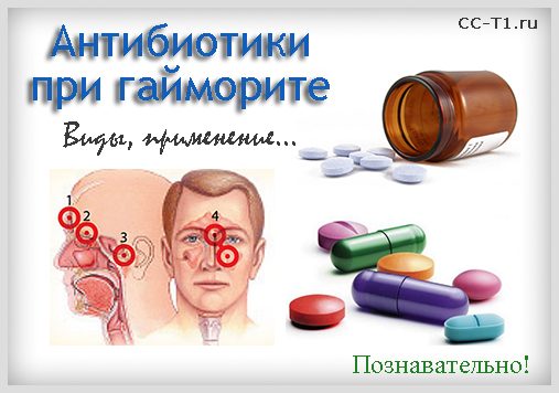 Антибіотики при гаймориті: які з них варто використовувати Антибіотики при гаймориті: які з них варто використовувати
