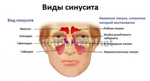 Антибіотики при нежиті і риніті у дорослих – найкращі засоби 2019