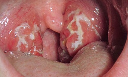 Антибіотики при тонзиліті у дорослих