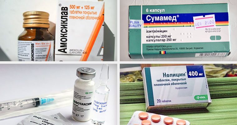 Антибіотики при запаленні придатків і яєчників застосовуються жінками
