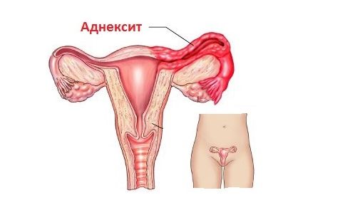 Антибіотики при запаленні придатків і яєчників застосовуються жінками