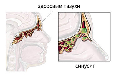 Аптечні засоби для промивання носа
