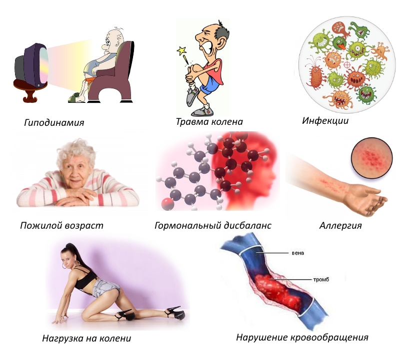 Артрит колінного суглоба лікування народними засобами
