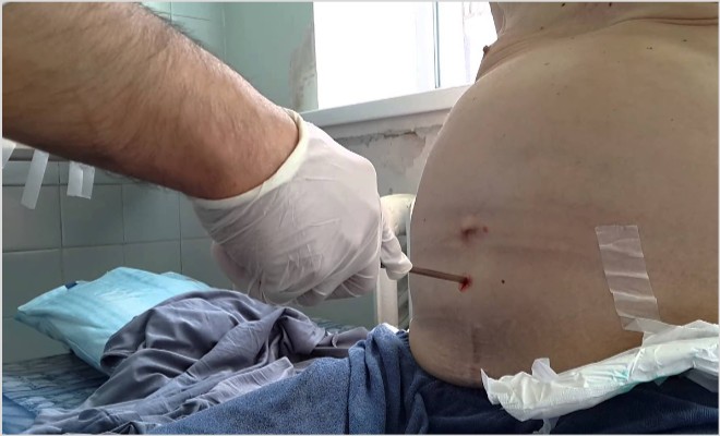 Асцит черевної порожнини лікування народними засобами — Все про печінки