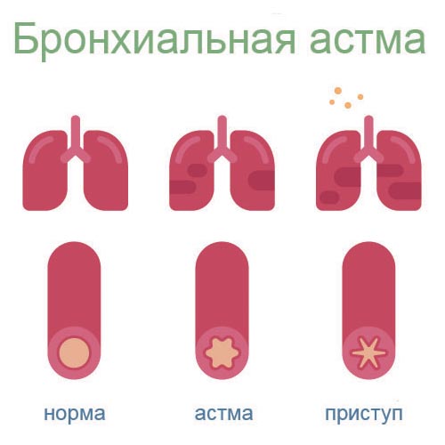Астма причини симптоми можливе лікування