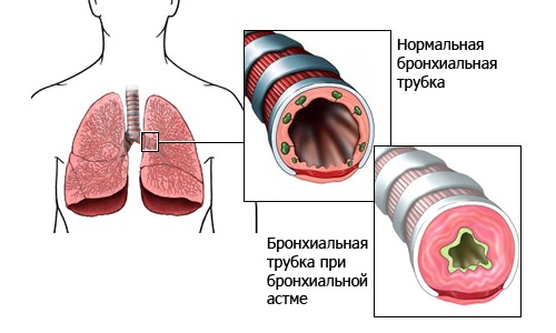 Астма причини симптоми можливе лікування