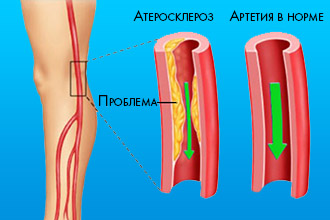 Атеросклероз судин нижніх кінцівок — лікування народними засобами Атеросклероз судин нижніх кінцівок — лікування народними засобами