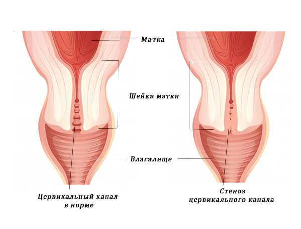 Атрезія матки: причини, симптоми і лікування