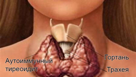 Аутоімунний тиреоїдит щитовидної залози