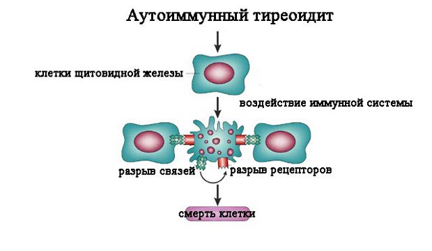 Аутоімунний тиреоїдит щитовидної залози