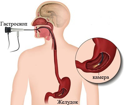 Біль у горлі при ковтанні може бути симптомом ряду захворювань: основні причини патологічного стану і способи лікування, можливі хвороби
