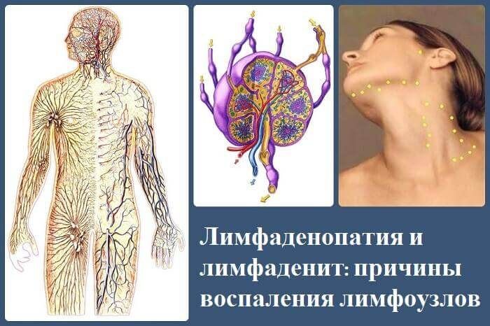 Біль у горлі і запалені лімфовузли: можливі захворювання і методи лікування. Запалені лімфовузли на горлі і дієві методи лікування