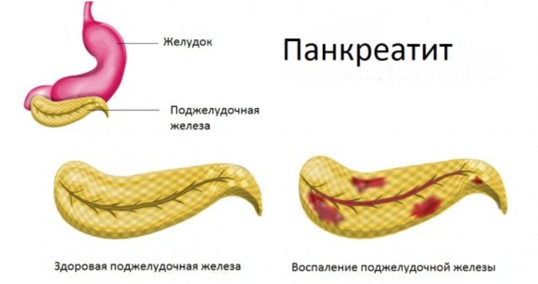 Біль у правому боці Біль у правому боці