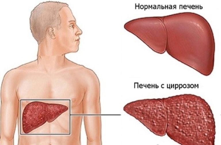 Біль у правому боці Біль у правому боці