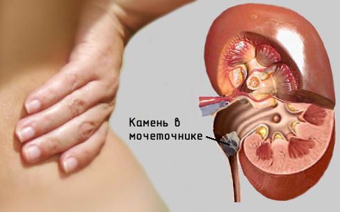 Біль у правому боці