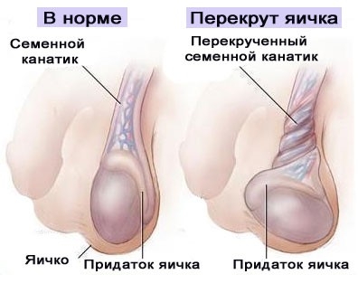 Біль у правому яєчку і паховій області причини і як лікувати