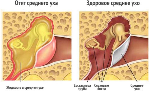 Біль у вусі при глотаниии причини і лікування