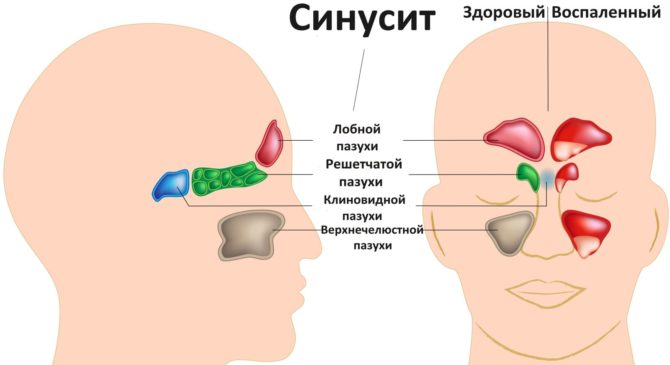 Білий наліт на гландах – у дитини, без температури, що це, у дорослого, Чим лікувати, фото, ангіна, з температурою