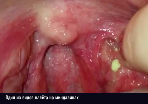Білий наліт на гортані: чому виникає і як лікувати?