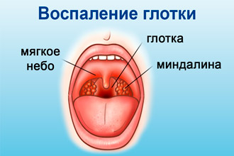 Бактеріальний фарингіт – причини, симптоми, лікування