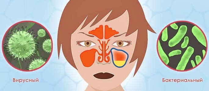 Бактеріальний гайморит симптоми Хвороби носа