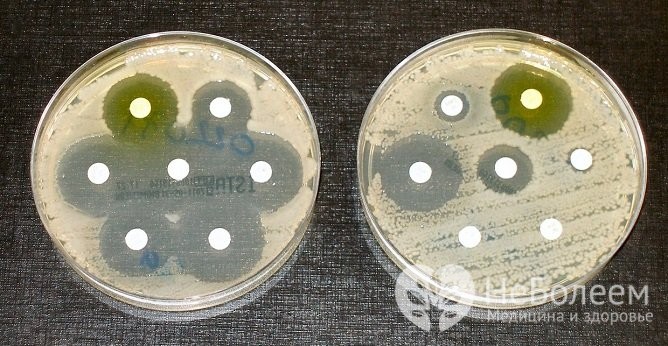 Бактеріологічний посів сечі – що показує і як здавати?