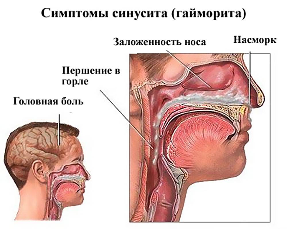 Бальзам Золота зірка при гаймориті