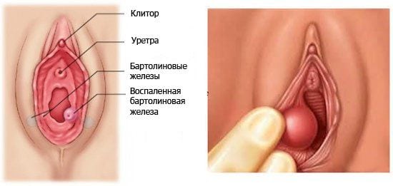 Бартолініт у жінок: симптоми і лікування