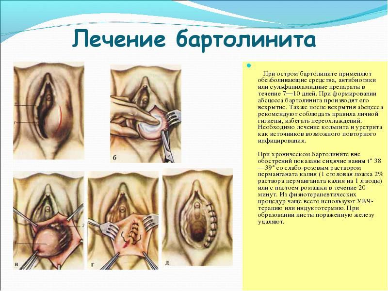 Бартолініт у жінок: симптоми і лікування