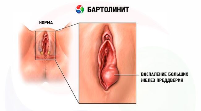 Бартолініт у жінок: симптоми і лікування